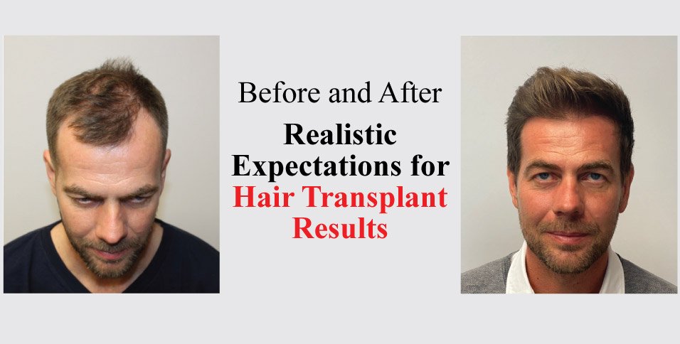 Hair Transplant Results