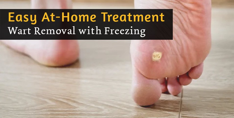 Wart Removal with Freezing