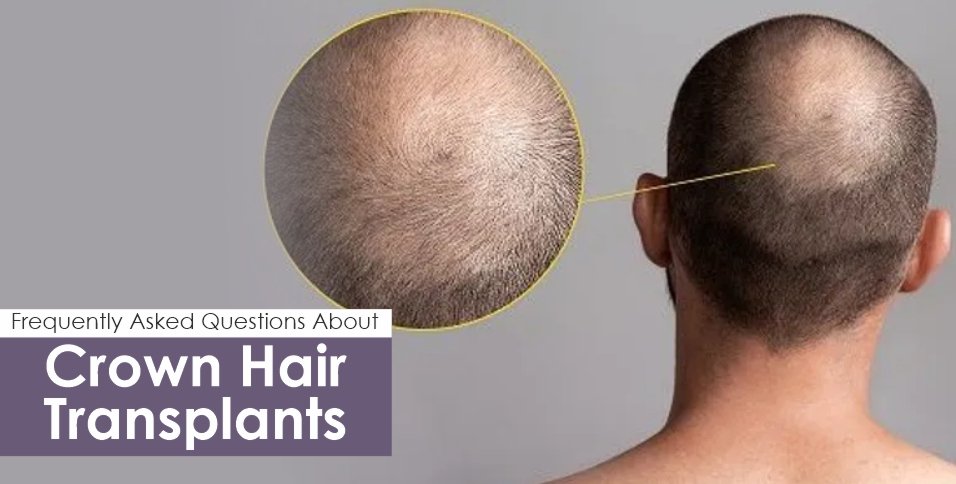 Crown Hair Transplants