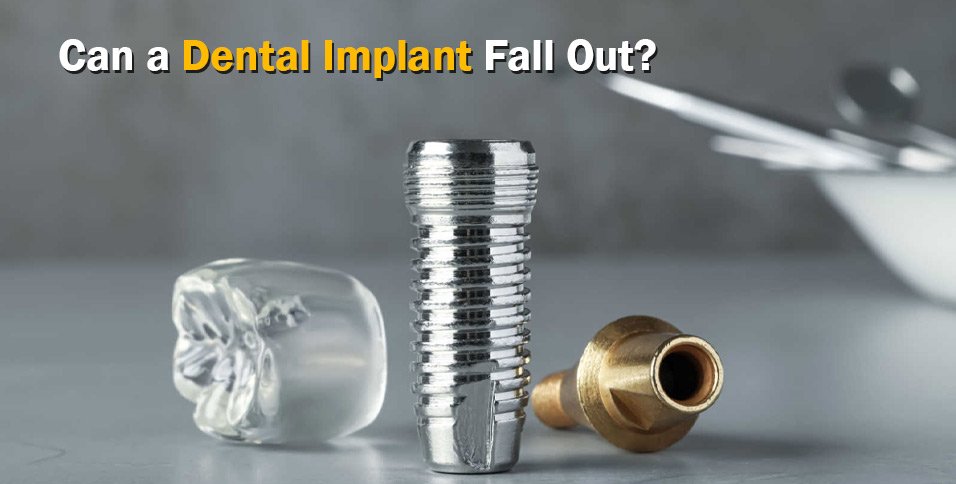 Can a Dental Implant Fall Out?