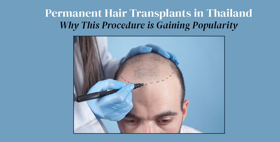 Permanent Hair Transplants