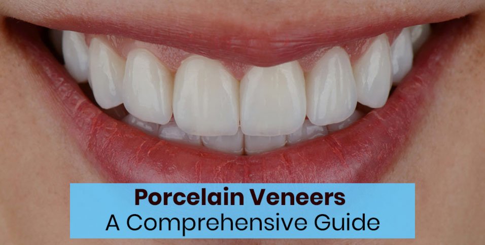 Porcelain Veneers