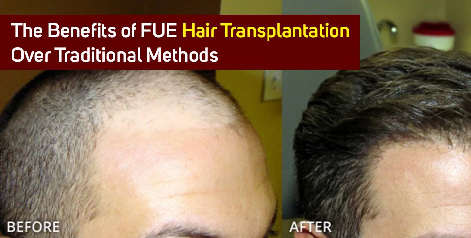 FUE Hair Transplantation