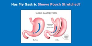 Has My Gastric Sleeve Pouch Stretched?