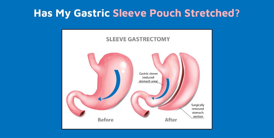 Gastric Sleeve Pouch Stretched