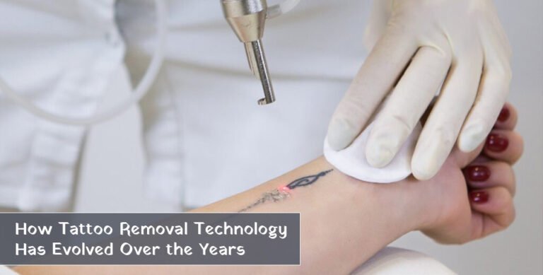 Tattoo Removal Technology