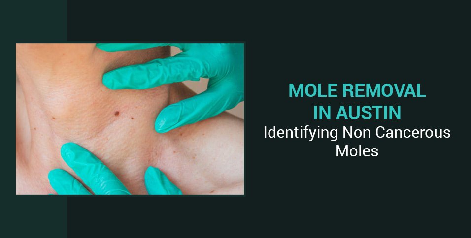 Mole Removal in Austin