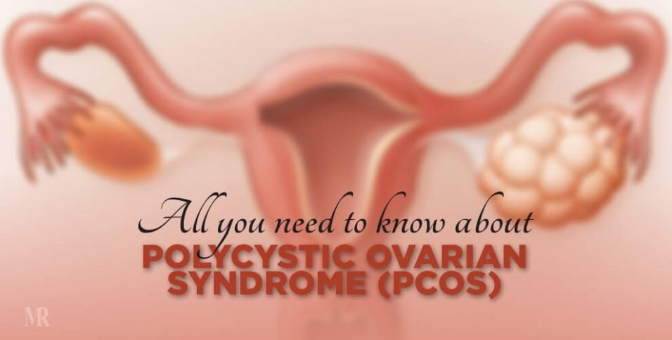 All You Need To Know About Polycystic Ovarian Syndrome Pcos Mr